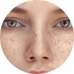 Facial Freckles