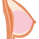 Gel-filled Breast
