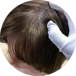 Implanted Human Hair