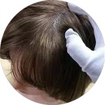 Implanted Human Hair