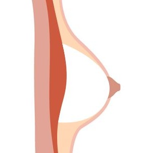 Hollow Breast