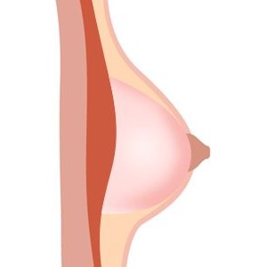 Gel-Filled Breasts