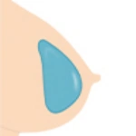Gel filled Breasts