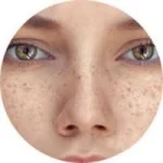 Facial Freckles